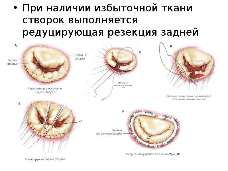 Замена митрального клапана видео