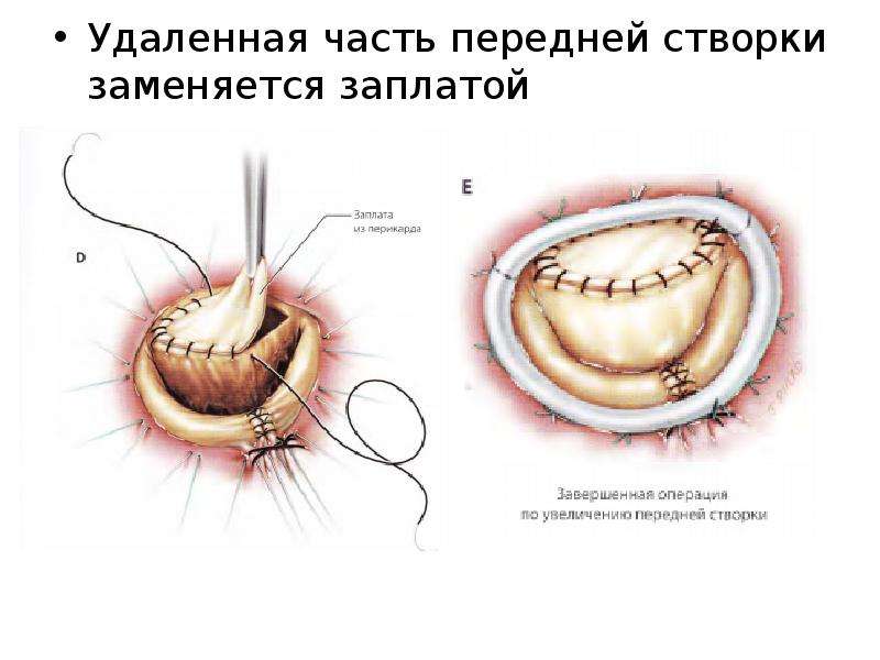 Удаление части. Реконструктивные операции на митральном клапане.