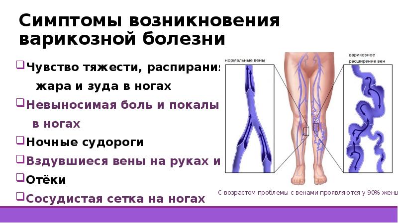 Тяжесть в ногах вены. Чувство тяжести в ногах. Причины возникновения варикозной болезни. Покалывание вен на ногах. Ощущение распирания в ногах.