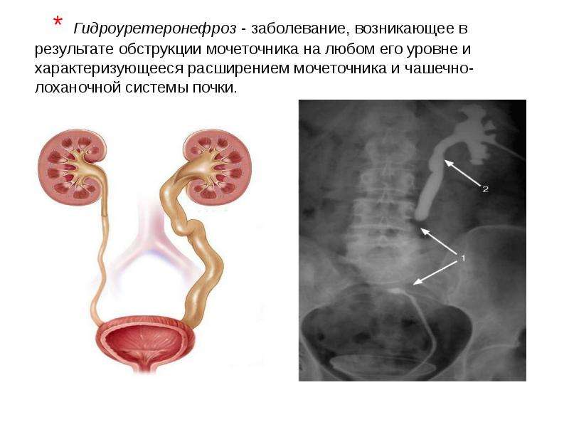 Мочекаменная болезнь урология презентация