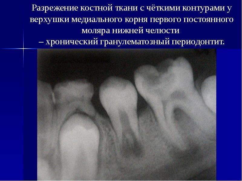 Разряжение костной ткани. Гранулематозный периодонтит рентген зуба. Периодонтит фиброзный гранулематозный гранулирующий. Остеопороз нижней челюсти рентген. Очаги разрежения костной ткани нижней челюсти.