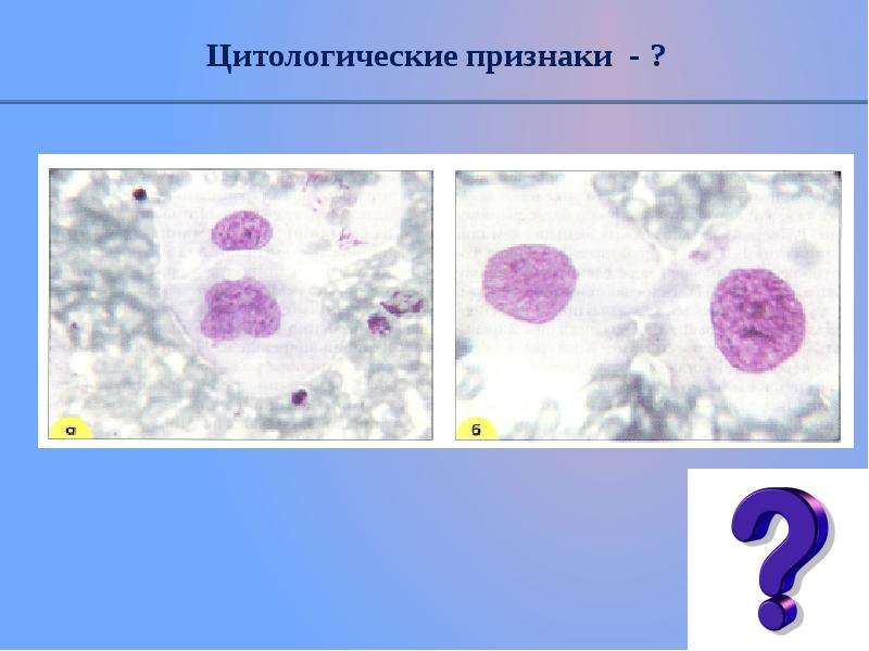 Цин 3. Признаки злокачественности. Дисплазия предстательной железы Cin-3. Гистологическая степень злокачественности по Elston Ellis g2 3+2+2 - 7+1 -6.