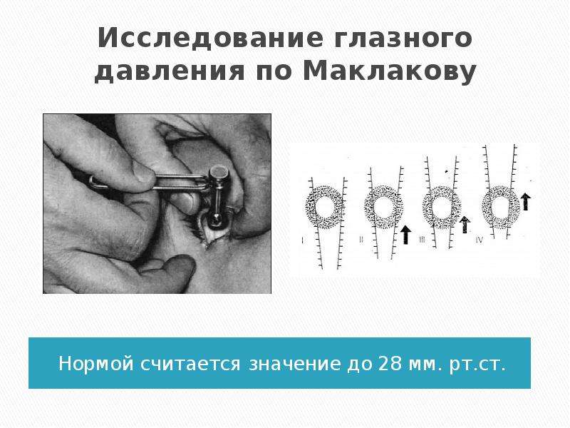 Тонометр маклакова используют для измерения тест. Измерение внутриглазного давления норма. Норма при измерении ВГД по маклакову. Измерение внутриглазного давления по маклакову алгоритм. Линейка для ВГД по маклакову.