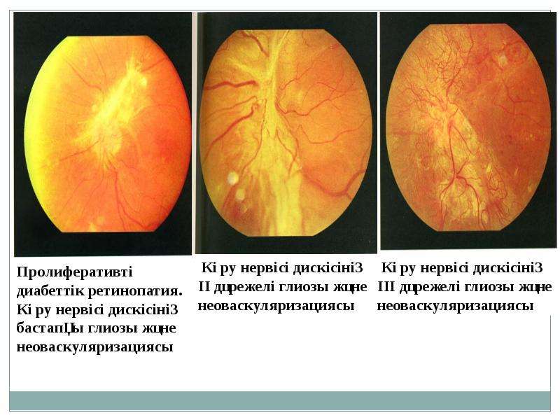 Диабеттік ретинопатия презентация
