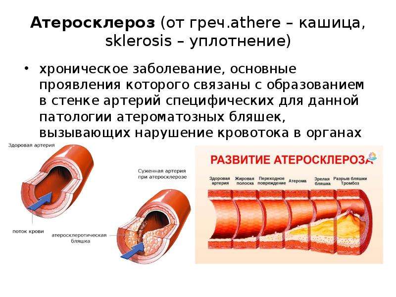 Атеросклероз причины. Развитию атеросклеротических поражений сосудов способствуют:. Повреждение стенок сосудов, атеросклероз;. Атеросклероз основные синдромы. Артериального атеросклероза \.