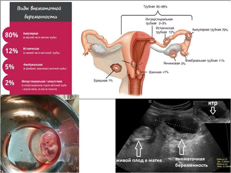 Внематочная беременность картинки