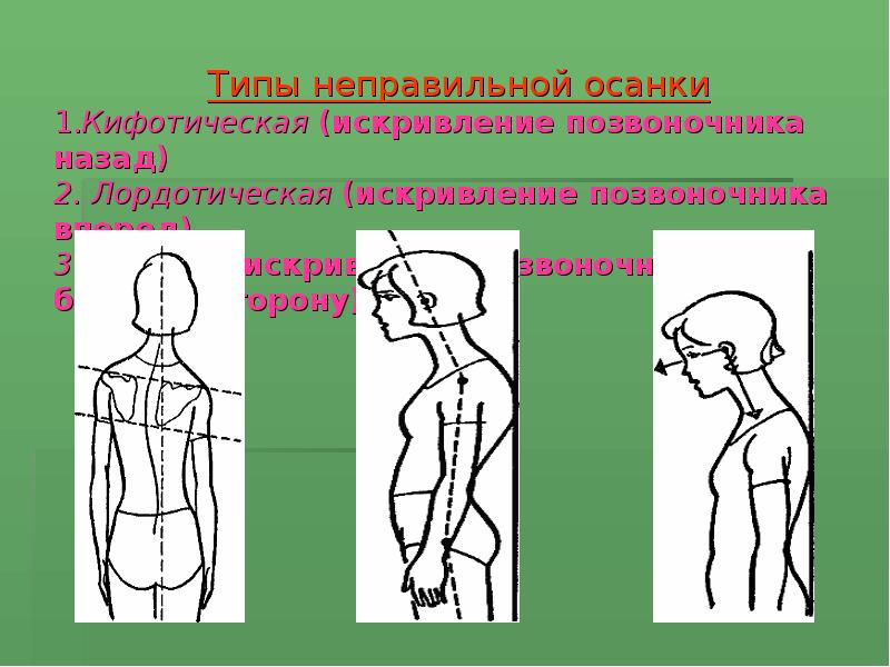 Все виды искривления позвоночника с картинками