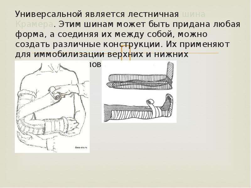 Постоянная иммобилизация презентация