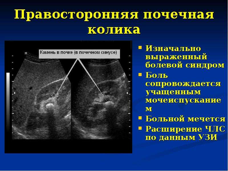 Аппендэктомия мкб. Почечная колика на УЗИ. Мочекаменная болезнь УЗИ. УЗИ при почечной колике. Камень в паренхиме почки УЗИ.