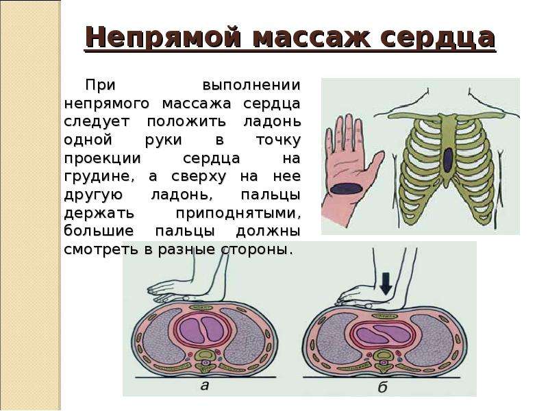 Непрямой сердца. Непрямой массаж сердца техника выполнения 1. Правила непрямого массажа сердца. Непрямой закрытый массаж сердца. Правила проведения непрямого массажа сердца.