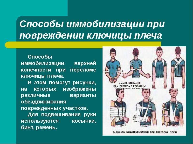 Транспортная иммобилизация при переломе ключицы