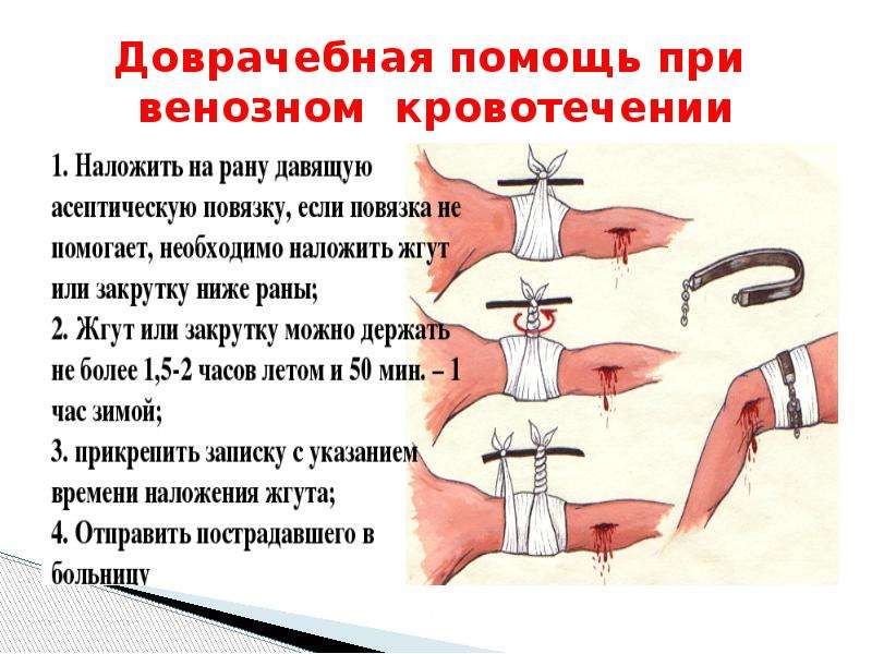 Какие действия при венозном кровотечении. Наложение жгута при венозном кровотечении. ПДП при венозном кровотечении. Венозное кровотечение накладывается жгут. Алгоритм оказания первой помощи при наружном венозном кровотечении..