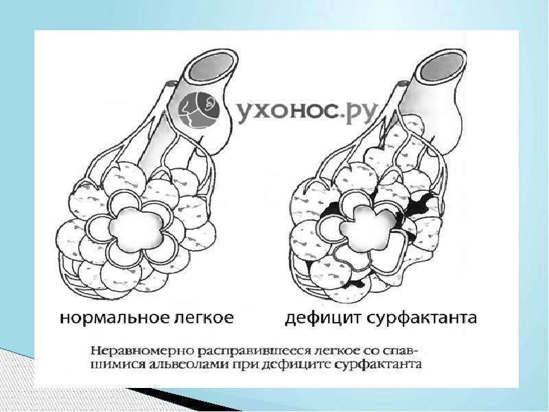 Повреждение легких. Острое повреждение легких схема. Легкие повреждения примеры. Острое альвеолярное повреждение при ушибе легкого. Индекс повреждения легких.