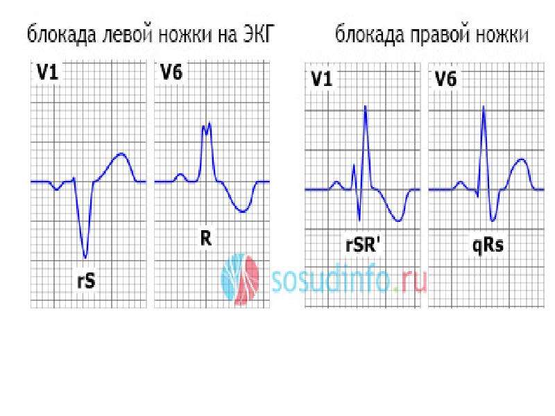 Блокада левого у сердца