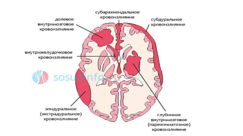 Презентация обж инсульт