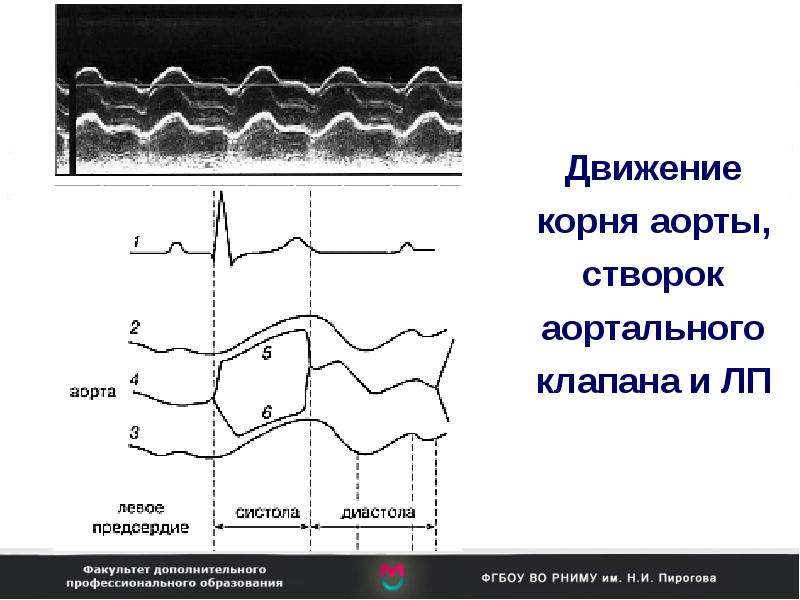 Уплотнение аорты створок аортального клапана. Стеноз аортального клапана ЭХОКГ. Мелковолновое дрожание створок аортального клапана в систолу.