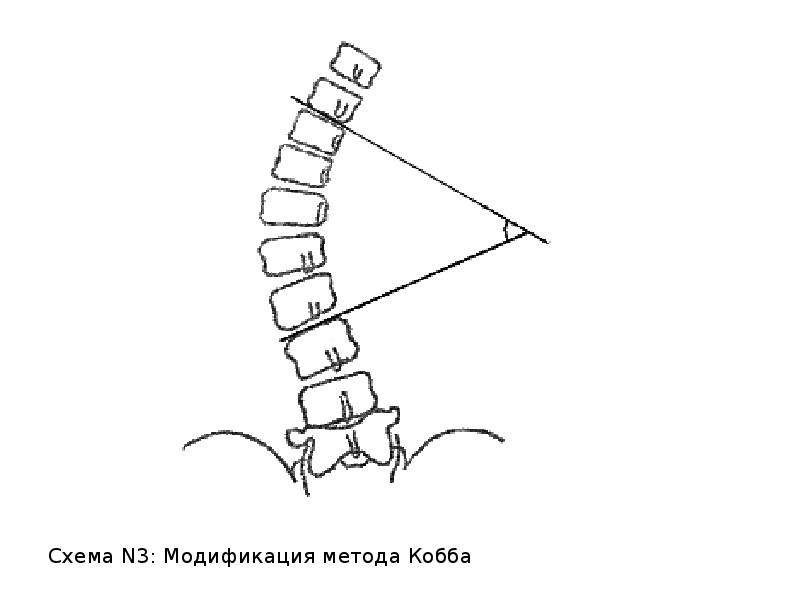 Степени кифоза грудного отдела позвоночника. Кифоз Кобба. Метод Кобба кифоз. Метод Кобба сколиоз. Угол кифоза 70 градусов.