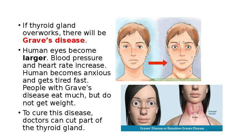 Thyroid condition Called Graves makes your Eyes bulge. Human disease