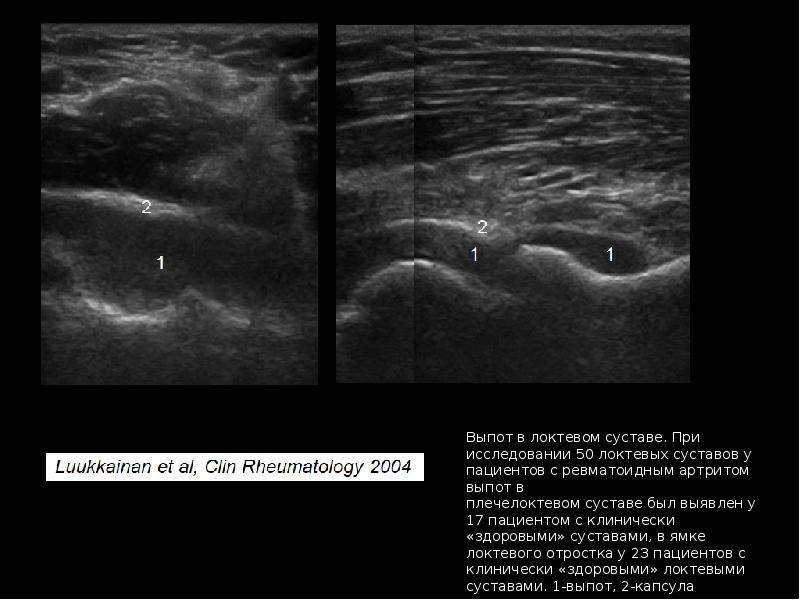 Узи суставов презентация