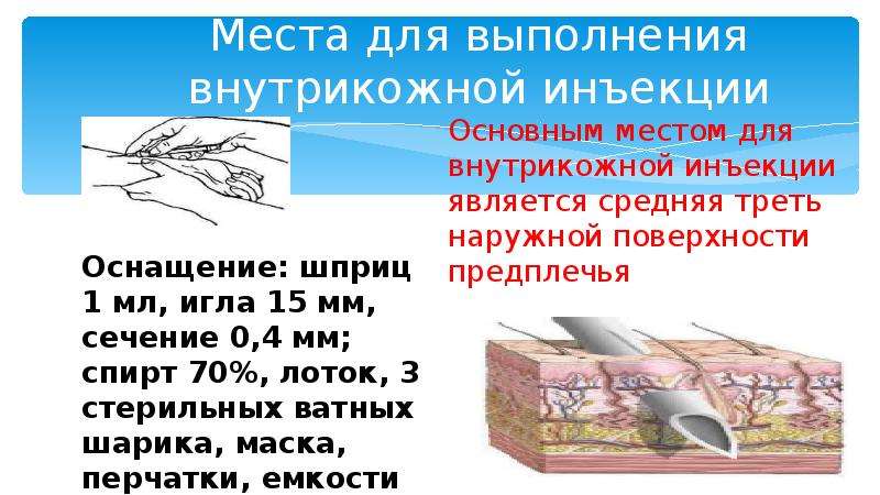 Анатомические места для внутрикожной инъекции